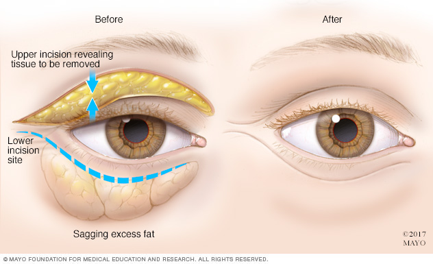 how to get rid of puffy baggy eyes