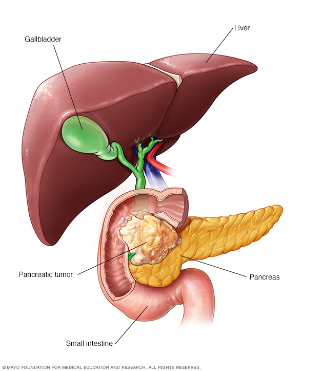 Cancer du pancréas