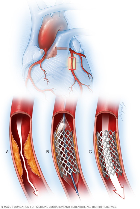 Stent de arteria coronaria