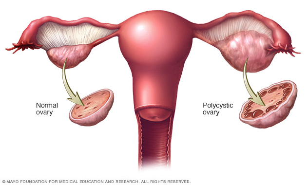 I have been spotting everyday for three months, what is wrong? I'm 18 and  have PCOS, is this normal? - Quora