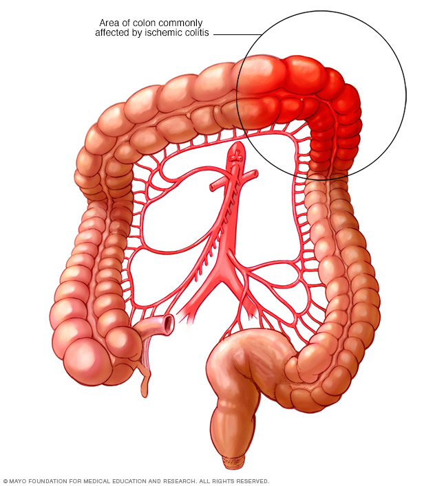 Болезнь кишок авиценна. Мезентериальный тромбоз кишечника. Ишемический колит кишечника. Атеросклероз брыжеечных артерий. Мезентериальные сосуды кишечника.