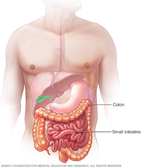 Intestinal ischemi: symtom, orsaker och behandling Intestinal ischemi: symtom, orsaker och behandling