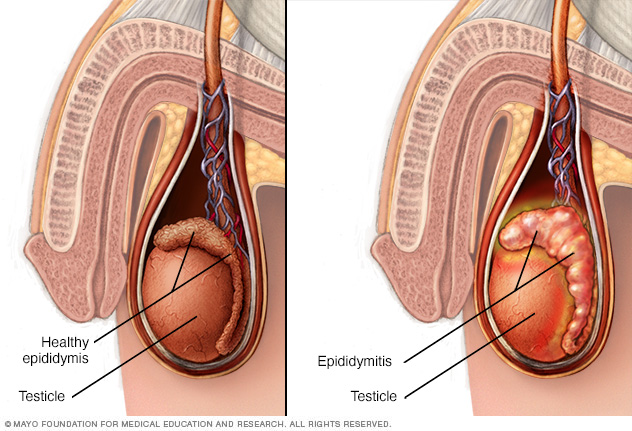 Skrotum, testis ve epididim.  Epididimit, testisin arkasındaki küçük, sarmal tüpün (epididimis) iltihaplanmasıdır.