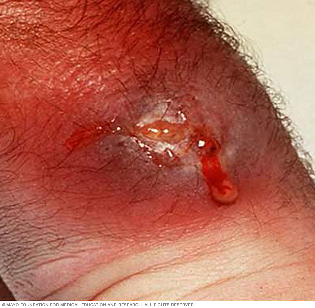 Folliculitis Disease Reference Guide Drugs Com