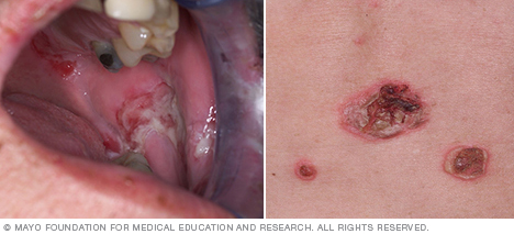 Pemphigus: oireet, syyt ja hoito