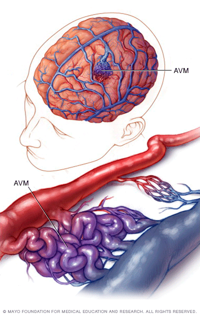 Brain AVM (arteriovenous malformation) Disease Reference Guide - Drugs.com