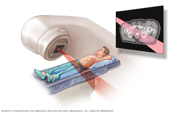 Externí paprskové záření pro rakovinu prostaty