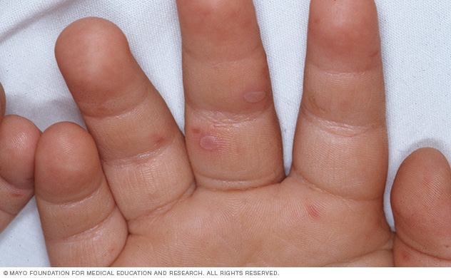 Hand Foot And Mouth Disease Disease Reference Guide