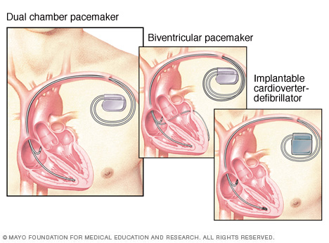 Pacemakers, defibrillator