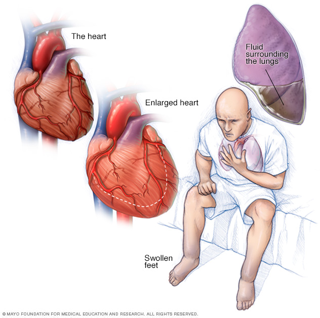 Symptômes et causes de l'insuffisance cardiaque