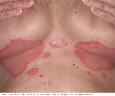 Omvendt psoriasis