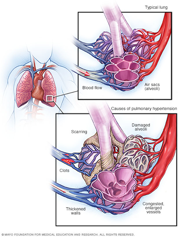 Sodium Intake and Pulmonary Arterial Hypertension