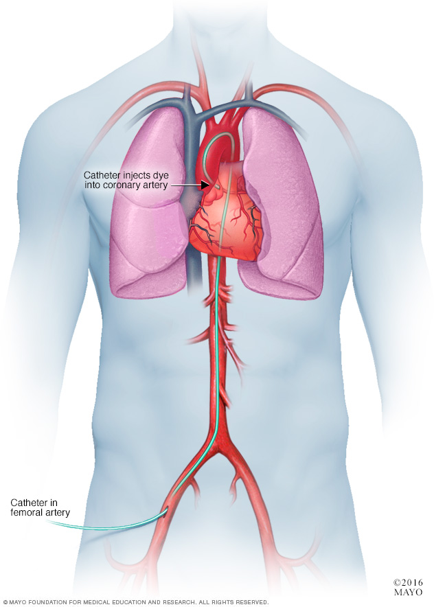 Angiogram koronari