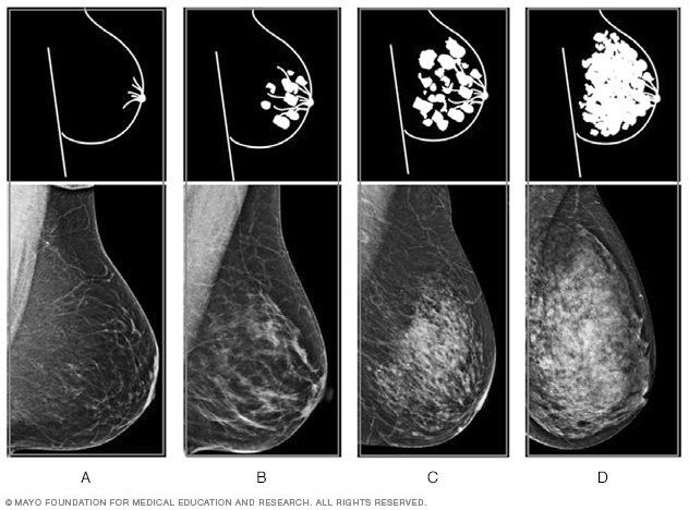 Dense Breast Tissue What It Means To Have Dense Breasts 