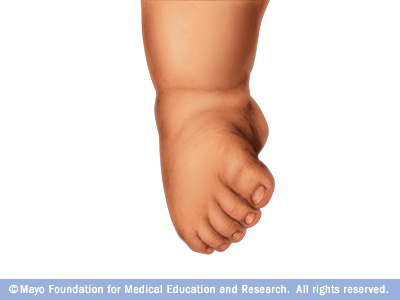 Clubfoot Disease Reference Guide Drugs Com Clubfoot Disease Reference Guide Drugs Com