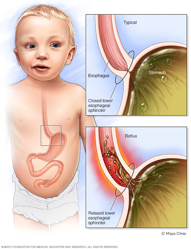 Hogyan alakul ki a csecsemő reflux