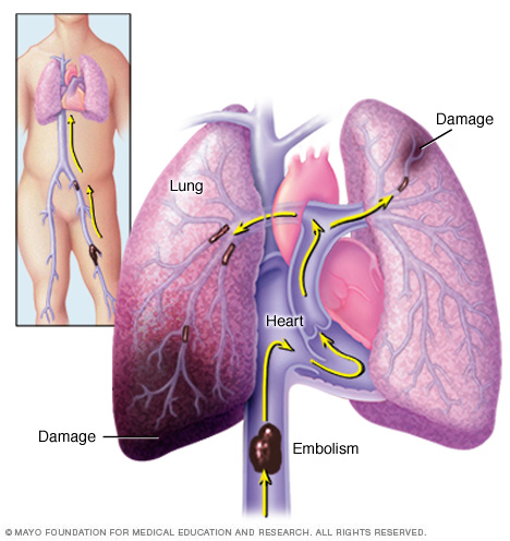 Embolisme pulmonari