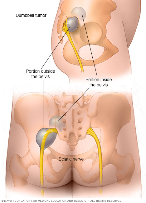 Dumbbell tumor