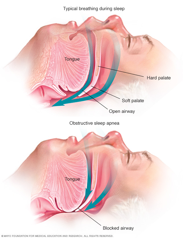 Symptomen van obstructieve slaapapneu