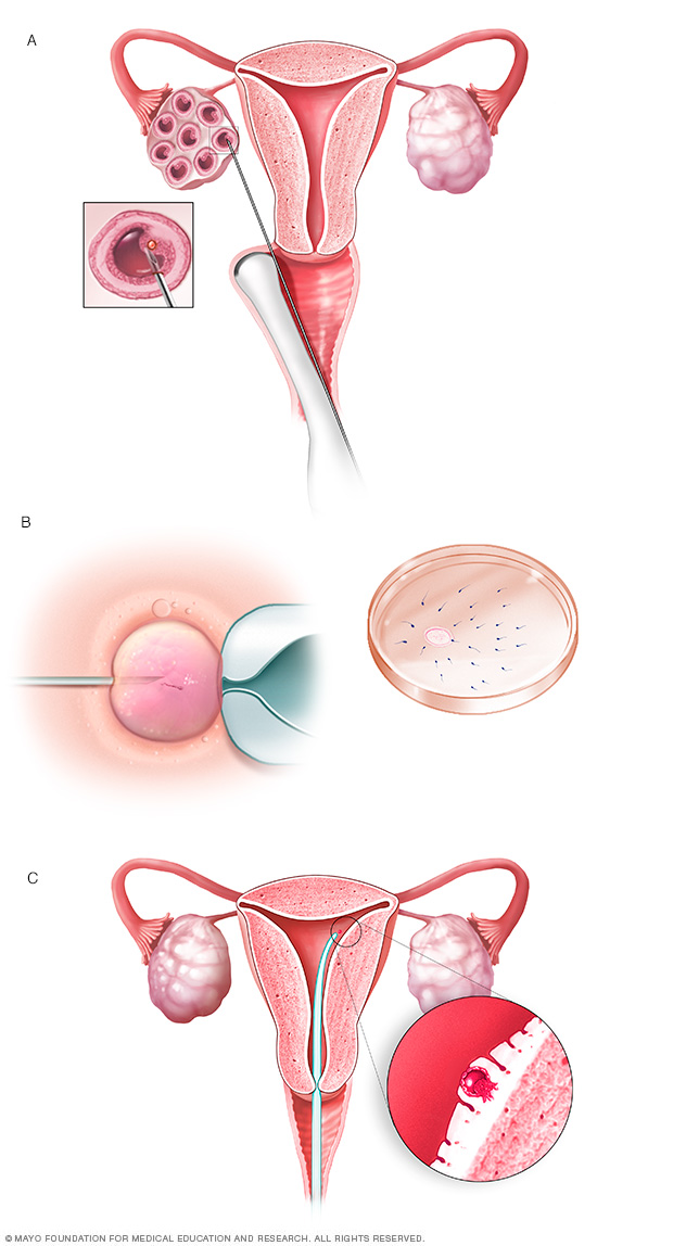 In vitro fertilizace