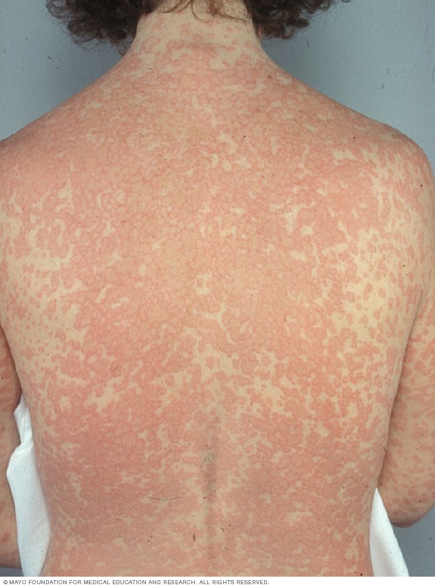 Penicillin Allergy Disease Reference Guide Drugs