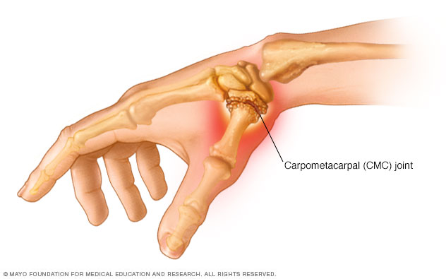 Artritis ibu jari.  Artritis ibu jari berlaku apabila tulang rawan dalam sendi carpometacarpal haus.