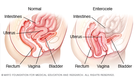 Prolapso do intestino delgado (enterocele)