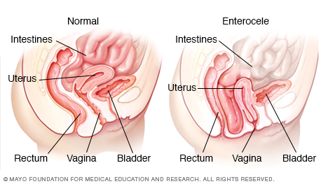 Tyndtarmsprolaps (enterocele)