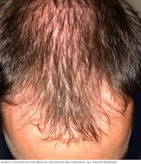 Male-pattern baldness