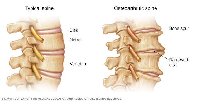 L'arthrose de la colonne vertébrale