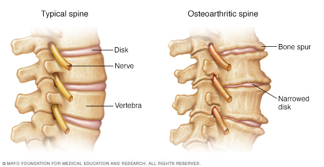 Osteoartrita coloanei vertebrale