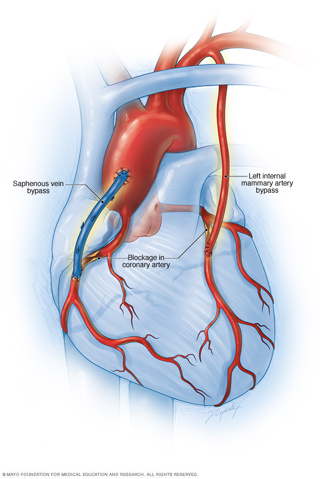 Cirugía de bypass coronario