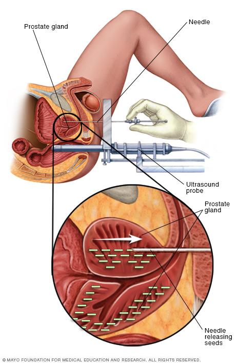 brachytherapy ต่อมลูกหมากถาวร