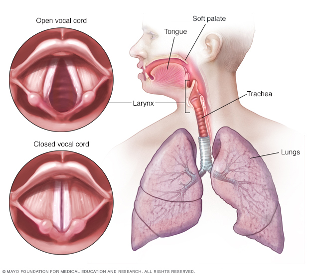 laryngitis