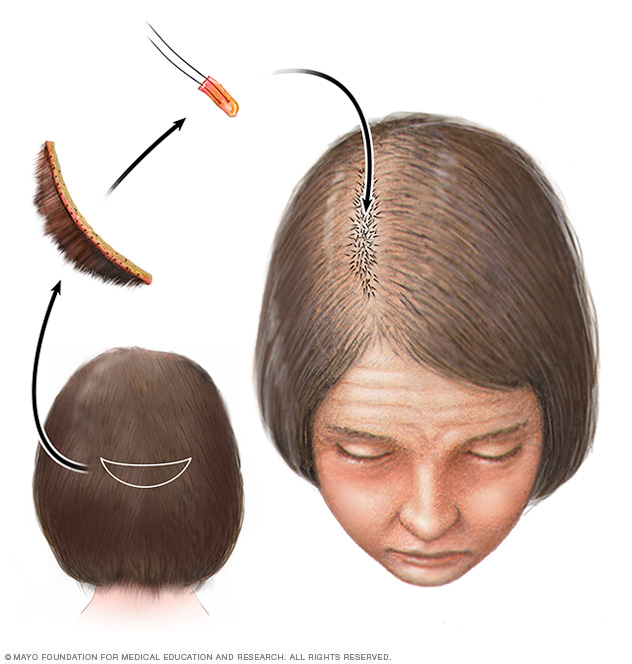 Haartransplantation