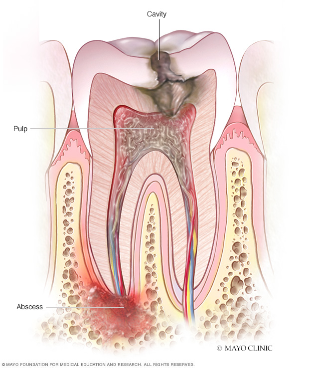 For pain tramadol tooth abscess