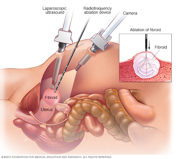 Laparoskopische Radiofrequenzablation