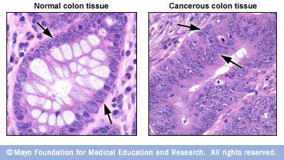 Qu'est-ce que le cancer?  Comment empêcher?