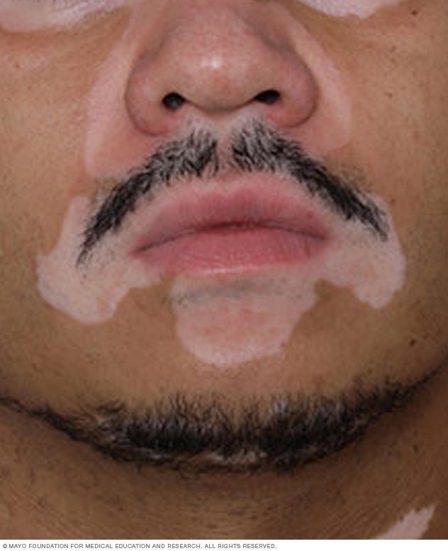 Vitiligo op het gezicht