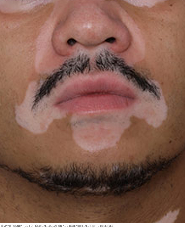 Vitiligo az arcon