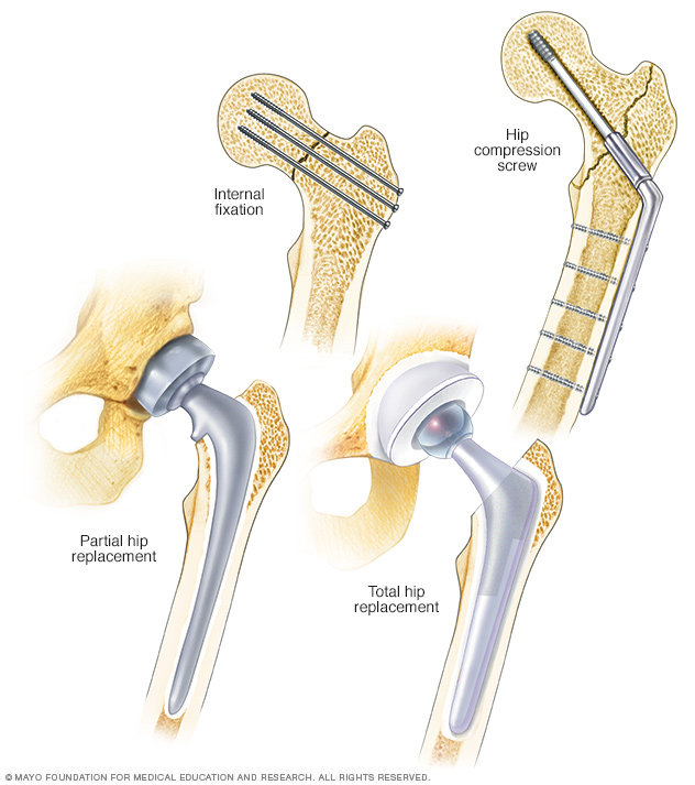 Тазобедренный сустав операция показать. Перелом шейки бедра остеосинтез. Тазобедренный сустав перелом шейки бедра. Перелом шейки бедра операция эндопротез. Протезы шейки бедренной кости.