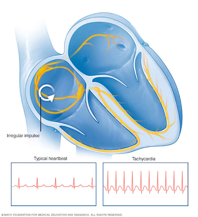 Symptomen en oorzaak van tachycardie