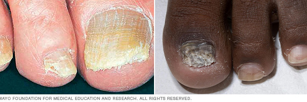 Nagelpilz: Symptome, Ursachen und Behandlung Nagelpilz: Symptome, Ursachen und Behandlung