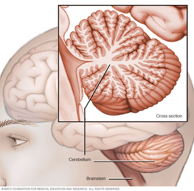 สาเหตุและอาการของ ataxia สาเหตุและอาการของ ataxia