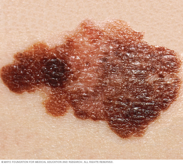 melanoma 