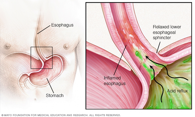 Heartburn: What It Feels Like, Causes & Treatment