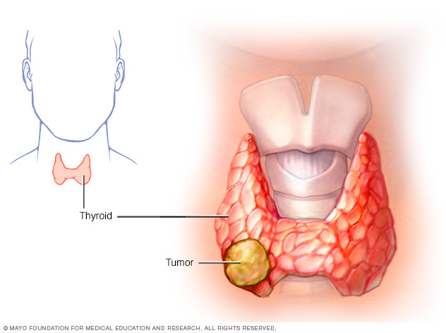 Síntomas y causas del cáncer de tiroides.