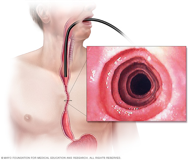 oesophagitis