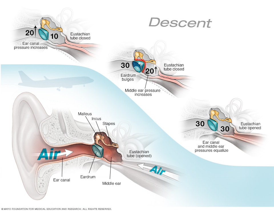 air travel ear infection