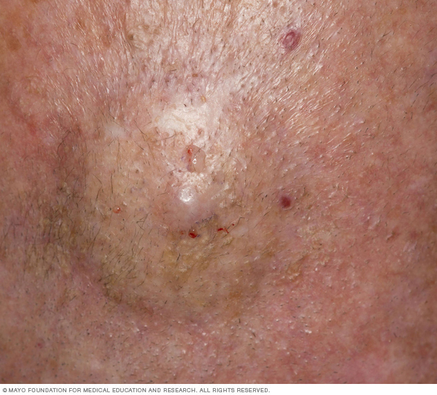cutaneous t cell and b cell lymphoma